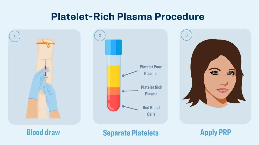 blood-derived-growth-factor-procedure